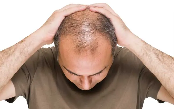 کدام استروئید باعث ریزش مو میشود؟