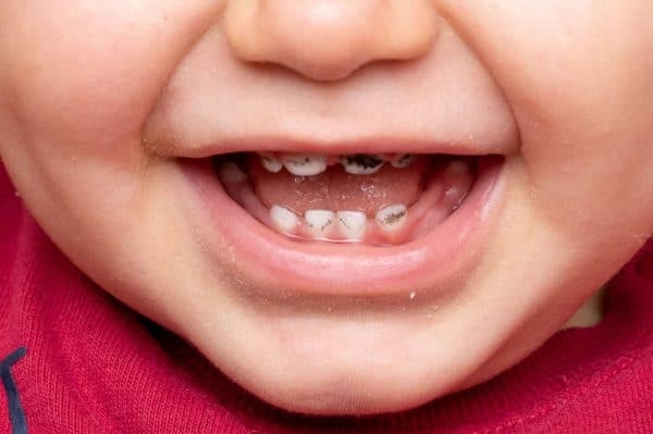 آیا مولتی ویتامین باعث سیاه شدن دندان میشود؟